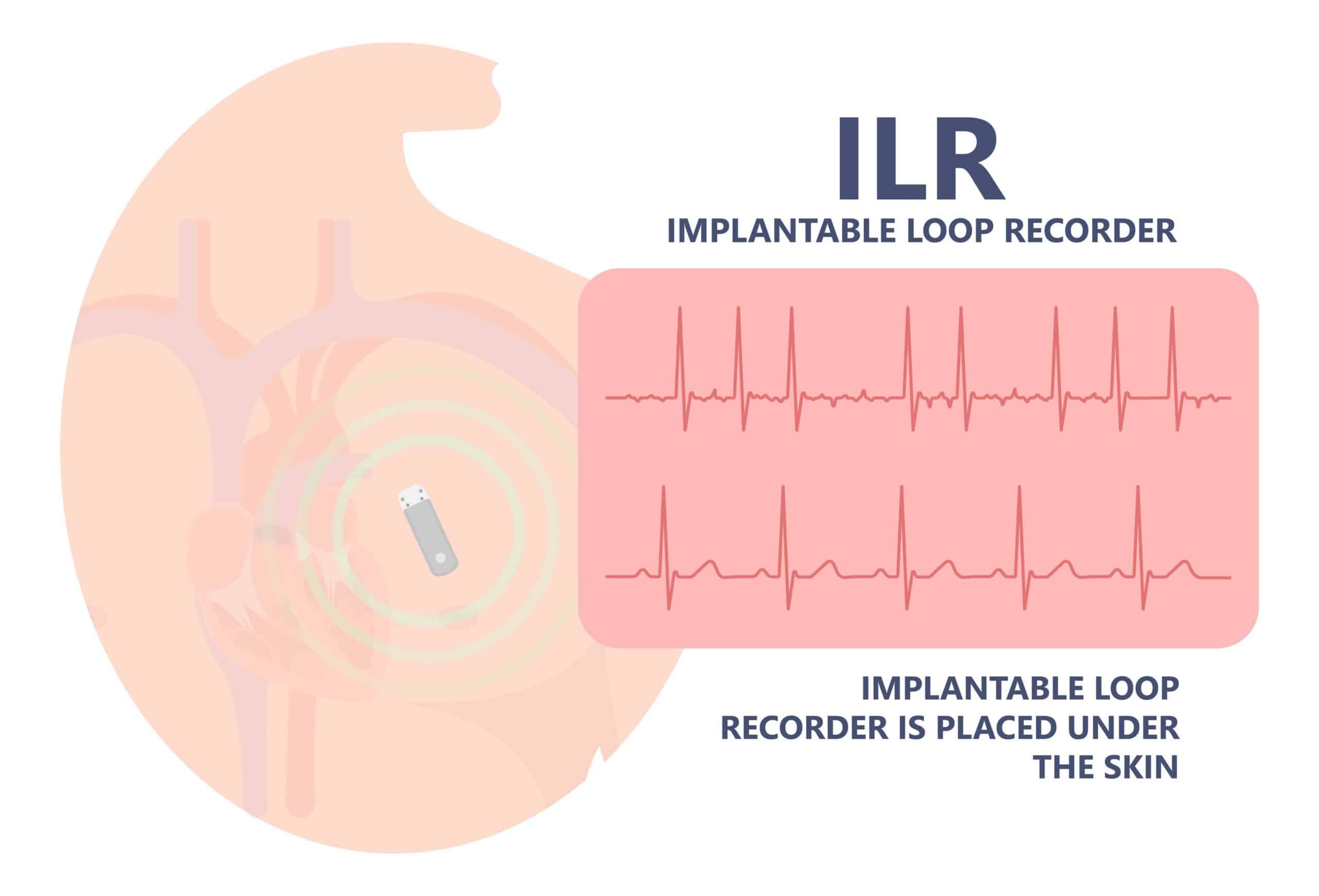 Loop Recorder Implantation